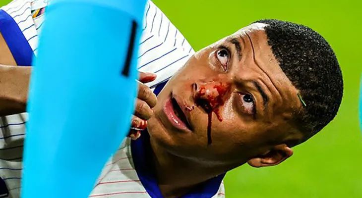 युरोकपमा फ्रान्सको विजयी शुरुवात, एम्बाप्पेको नाक भाँचियो